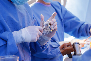 Surgeon applies bone cement to knee implant during total knee arthroplasty