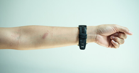 Cropped shot view of woman showing her arm after she feel itching from mosquito bites. Avoid scratching, as this can worsen the irritation and potentially lead to infection.