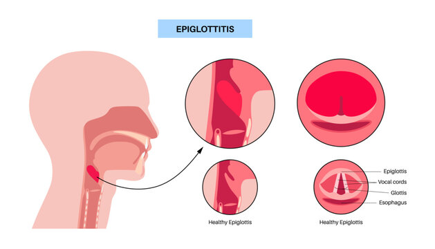Epiglottitis medical poster