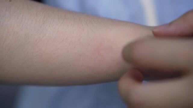 Close up of a woman is scratching her forearm after being bitten by mosquitoes in the park