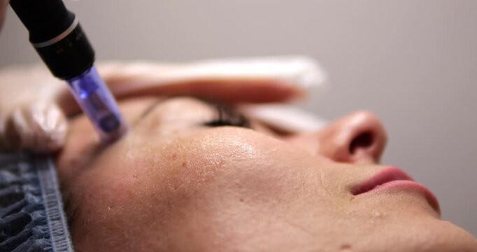 Cosmetic procedure microneedling. Facial skin care. A woman undergoes a procedure for restoring and regenerating facial skin. A cosmetologist works in a cosmetic office.
