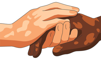 Portrait of a vitiligo sufferer shaking hands with different skin tones. Unique skin pigmentation highlighting natural beauty. World vitiligo day. Skin depigmentation, skin disorder.