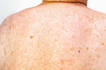 Skin cancer, malignant tumor prevention, health care, oncology risk, dermatology disease. Senior woman with moles, papillomas and pigmentation spots on her back.