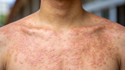 Fototapeta premium Inflamed skin lesions on chest and neck inflammation