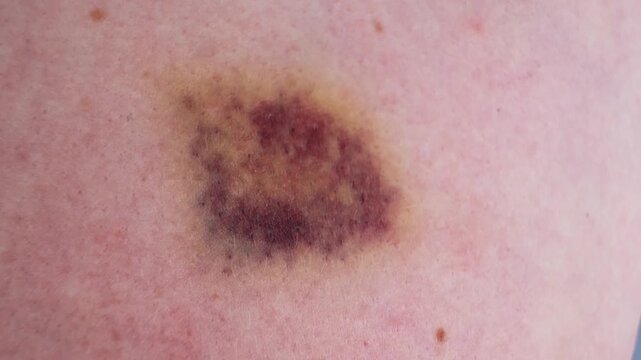 The bruise on skin close-up view. Various shades of healing process. Dark purple and yellow bruising colors on white skin. The violence concept. The consequences of injury. High quality 4k footage.