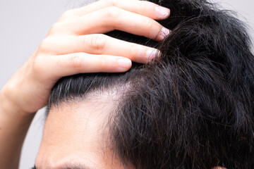 薄毛を気にする男性（M字に後退する額）