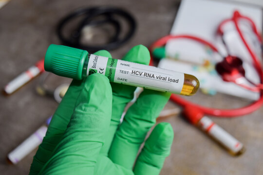 HCV RNA viral load vaccination drug in green gloved hands. Medical concept