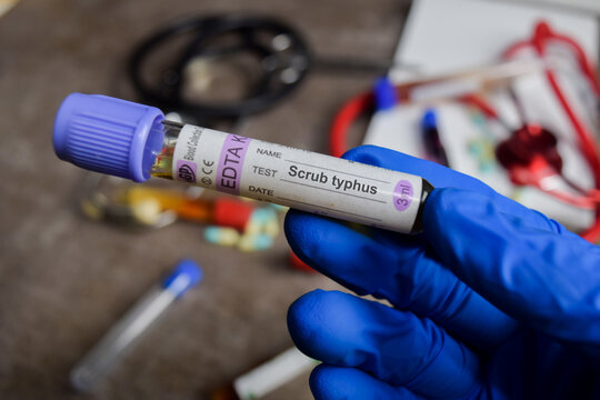 Scrub typhus vaccination drug in blue gloved hands. Medical concept