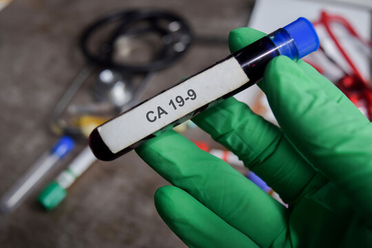 Electrolyte vaccination drug in green gloved hands. Medical conceptCA 19-9 vaccination drug in green gloved hands. Medical concept