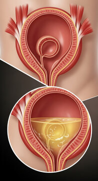 Anatomical illustration showing an empty bladder and a bladder filled with urine in detail
