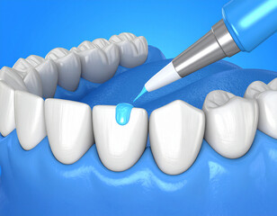 Dental care application of blue gel on white teeth treatment