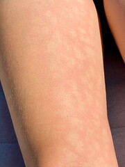 Spots on the skin of the leg - sun allergy