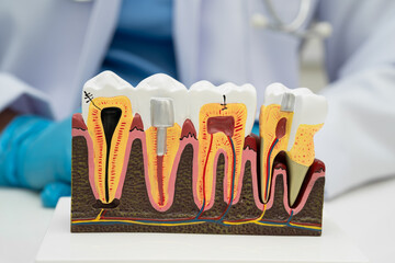 Dental implant, artificial tooth roots into jaw, root canal of dental treatment, gum disease, teeth...
