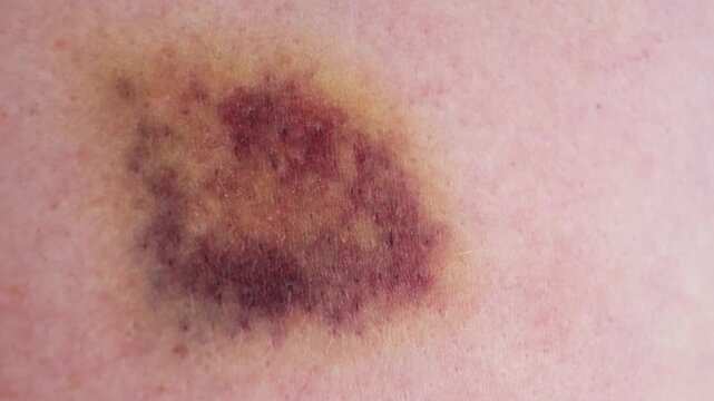 The bruise on skin close-up view. Various shades of healing process. Dark purple and yellow bruising colors on white skin. The violence concept. The consequences of injury. High quality 4k footage.