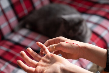 Scratches on a hand after playing with a cat resting on a sofa. Close-up of a child's hand with...