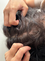 Brunette woman showing scalp psoriasis with flaking, redness, and irritation, top view close up....