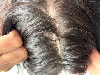 Brunette woman showing scalp psoriasis with flaking, redness, and irritation, top view close up....