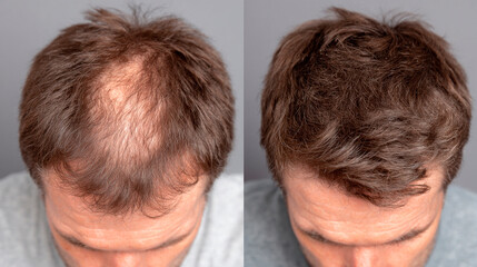 Hair Restoration: A striking before-and-after comparison showcases the transformative power of hair restoration. The image emphasizes the journey towards a fuller, more youthful head of hair.