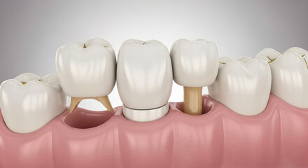 Detailed dental visualization showing tooth crown placement and preparation for implants or bridges