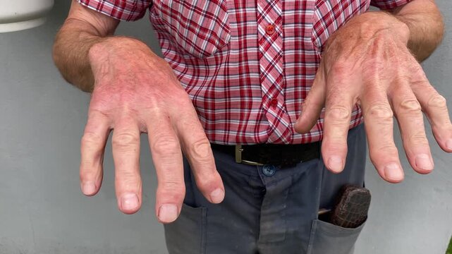 Close-up of elderly caucasian man's hands showing signs of rheumatoid arthritis. Hands are swollen and fingers are crooked and bent, indicating discomfort.