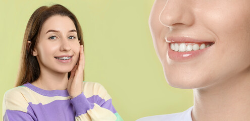 Woman showing perfect teeth as result of using dental braces on light green background, closeup. Collage with before and after photos