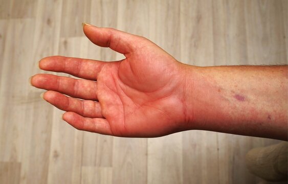 Painful swollen hand from a wasp sting