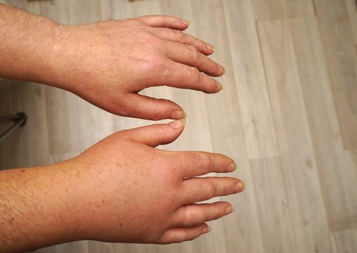 Painful swollen hand from a wasp sting