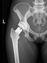 X-ray analysis of hip replacement surgery medical facility medical image clinical environment internal view health insight