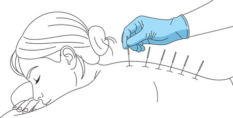 Gentle acupuncture treatment for pain relief and wellness, promoting relaxation