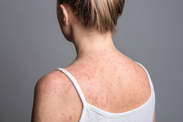 A woman with a red, spotty rash caused by measles.