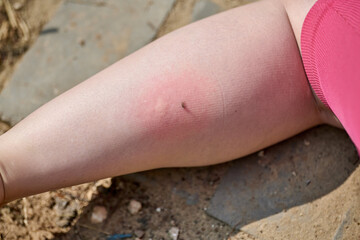 Red, swollen mosquito bite visible on leg during daylight. Outdoor setting with rough ground background. Shot captures discomfort and irritation from side angle