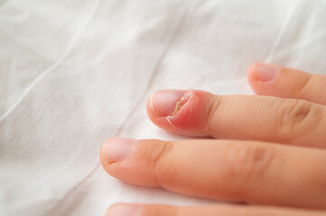 Painful purulent inflammation on a child's finger - paronychia.