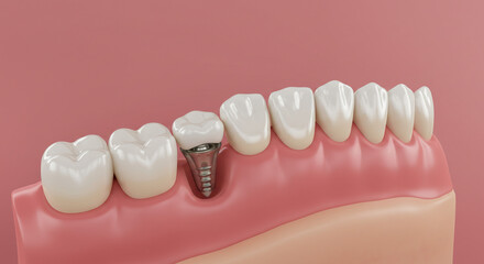 Discover the future of dental care with a detailed view of a dental implant seamlessly integrated with healthy teeth and gums