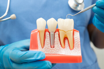 Dentist holding dental implant, artificial tooth roots into jaw, root canal of dental treatment,...