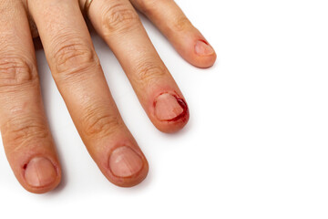 Manicure self made accident with blood wounds near the nail, self care injury concept, close up on white background