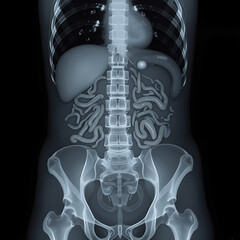 An abdominal X-ray shows complete coverage of the abdomen, with intestinal loops, kidneys, and surrounding structures visible. 