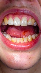 Close-up view of an open mouth displaying a range of teeth colors and some discoloration, along with a slightly inflamed or irritated oral cavity.