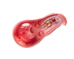 Detailed Medical Illustration of Atherosclerosis showcasing cholesterol build up inside an artery