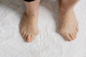Feet of an elderly woman with hallux valgus.