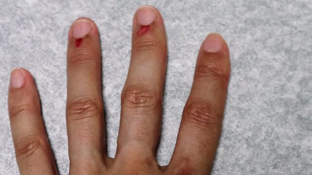 怪我をした指の動画
