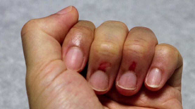 怪我をした指の動画