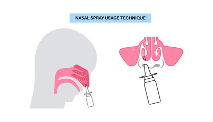 Proper nasal spray usage