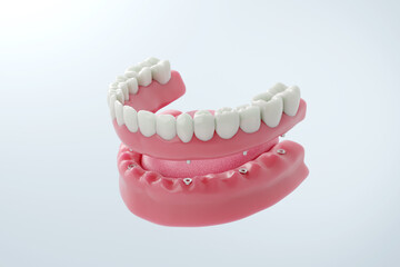 Full Jaw Reconstruction with a Dental Implant Bridge. 3D rendering