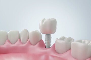 Placing a Ceramic Dental Crown on a Zirconia Implant 3D render