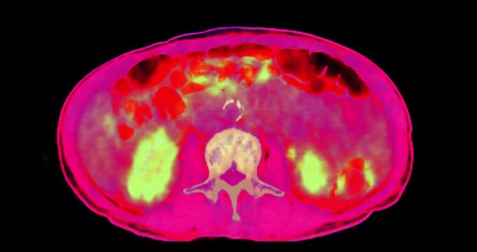 PET scan footage of the Whole Body scan highlighting areas of metabolic activity, essential for diagnosing conditions like Alzheimer's, tumors, and epilepsy.