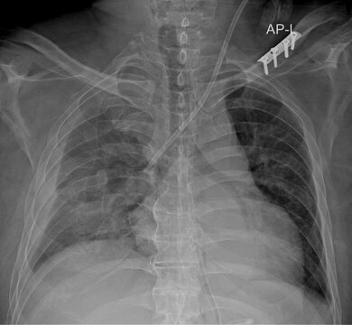 ICU chest X-ray showing clavicular surgical hardware and medical tubing &ndash; AP view with pulmonary opacities
