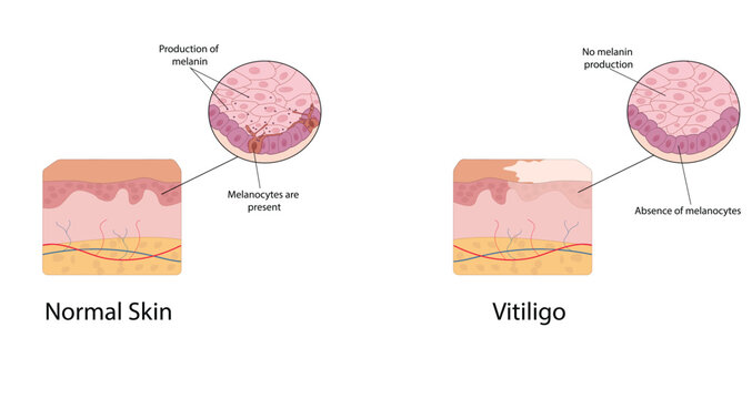 Vitiligo vector illustration