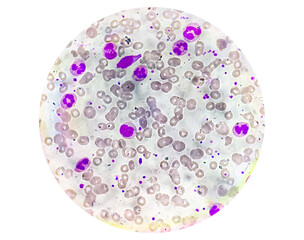 Photomicrograph of hematological slide showing RBC, WBC, Neutrophils and Eosinophil, Lymphocyte, Mono cytes and platelet. Abnormal hemogram. 