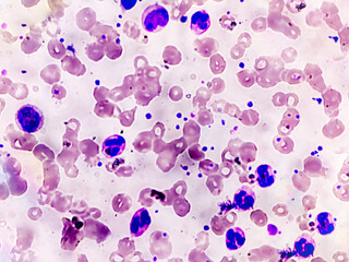 Photomicrograph of hematological slide showing RBC, WBC (Neutrophils and Eosinophil) and platelet. Normal hemogram. CBC
