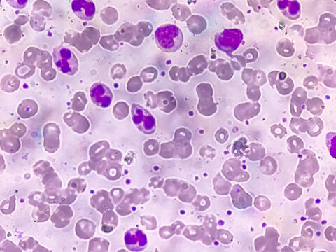 Photomicrograph of hematological slide showing RBC, WBC (Neutrophils and Eosinophil) and platelet. Normal hemogram. CBC